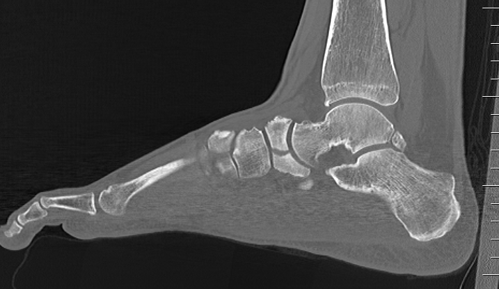 Navicular Fracture CT